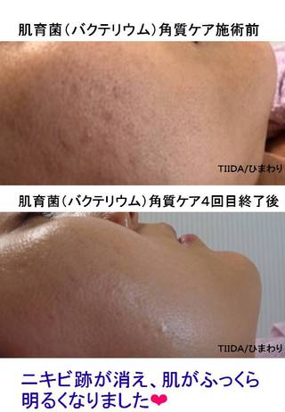 ニキビ跡・シミが薄くなった！！