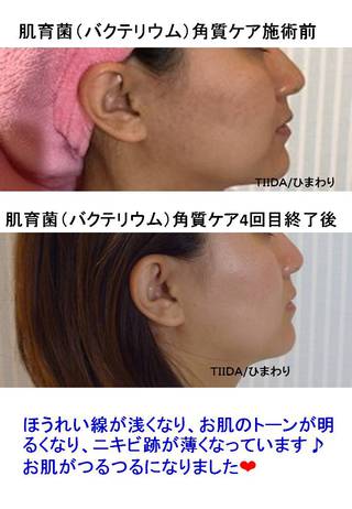 ニキビ跡・シミが薄くなった！！