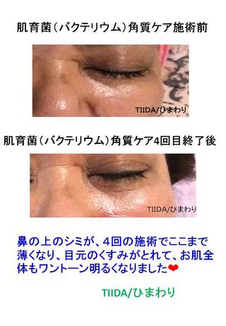 ニキビ跡・シミが薄くなった！！