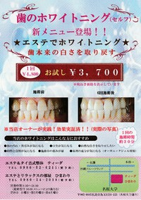 歯のホワイトニング♪♪ 2016/07/07 10:05:00