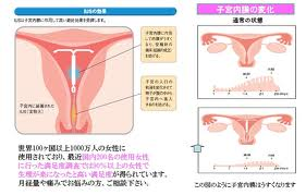 子宮内避妊具　ミレーナの紹介